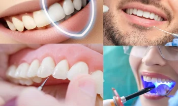 Düzce Diş Beyazlatma Uzman Kadro ve Deneyim Avantajları