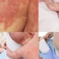 Erkek Bebeklerde Pişik Ve Yapılması Gerekenler